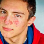 Whey Protein Dá Espinha? A Verdade Sobre o Aparecimento!