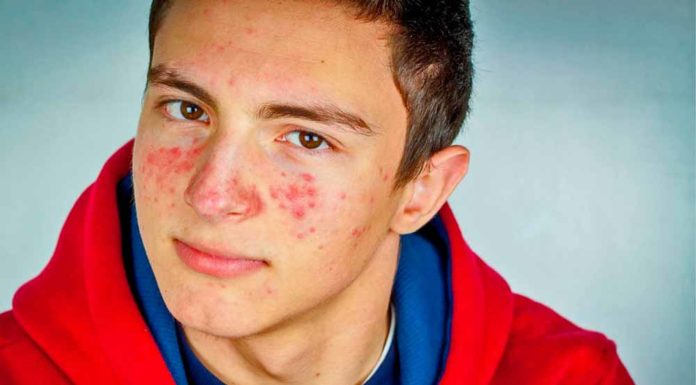 Whey Protein Dá Espinha? A Verdade Sobre o Aparecimento!