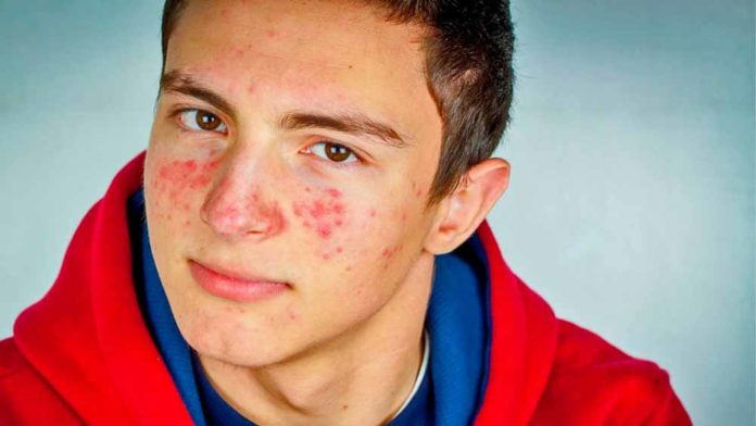 whey-protein-causa-acne
