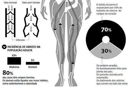 Infográfico sobre varizes