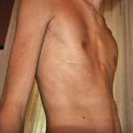 O Que é Peito Escavado e Quais Seus Tratamentos? Pectus excavatum