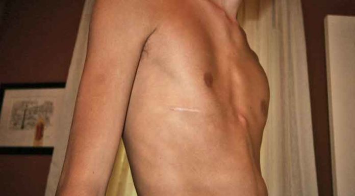 O Que é Peito Escavado e Quais Seus Tratamentos? Pectus excavatum