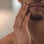 Hipercalórico Causa Acnes? Entenda a Relação entre Suplementos e Pele Hipercalórico causa acne?