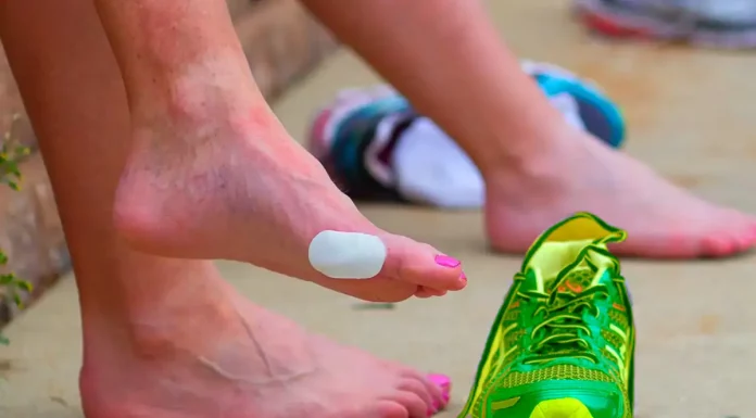 Como evitar bolhas na corrida: cuide dos seus pés e corra sem dor Bolhas no pé de uma corredora
